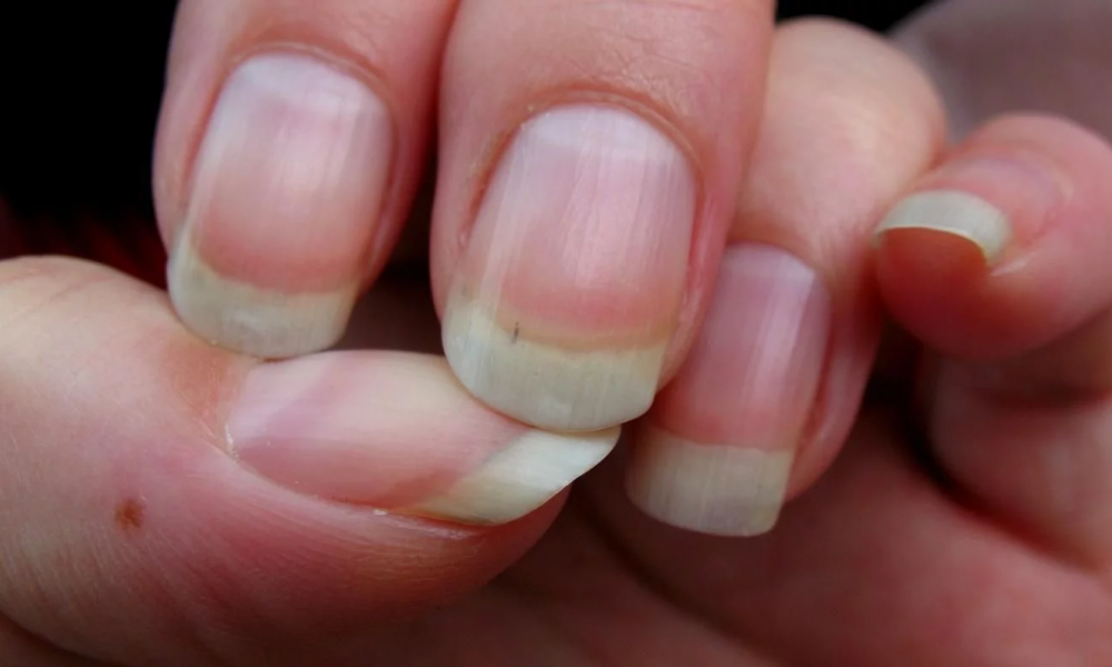 Nails, Nails indicates health status, Nails health, Keratin, Nails indicates diseases, Problems caused by nails, Pale Nails, Dots of nails, Horizontal Nails, Vertical Nails, Health news, Lifestyle news