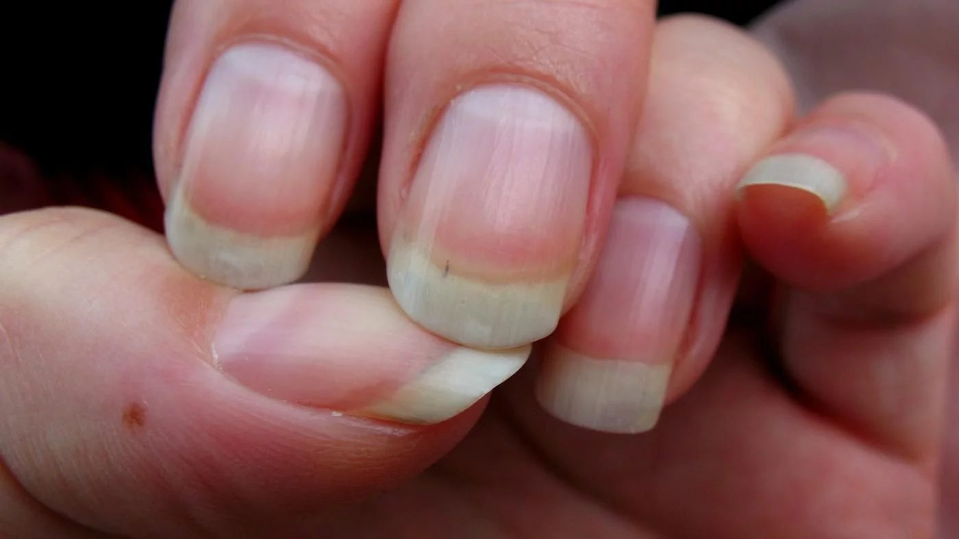 Nails, Nails indicates health status, Nails health, Keratin, Nails indicates diseases, Problems caused by nails, Pale Nails, Dots of nails, Horizontal Nails, Vertical Nails, Health news, Lifestyle news